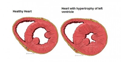 Health heart compared with heart showing hypertrophy of left ventricle