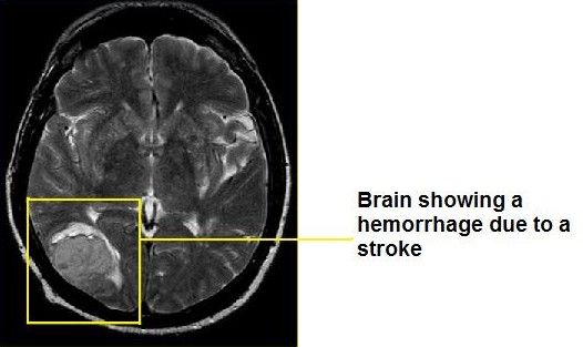 Stroke damage in the brain